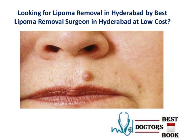 lipoma removal cost lipoma removal in hyderabad lipoma removal cost lipoma removal in hyderabad