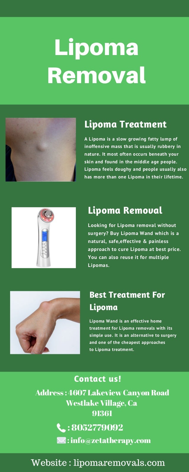 Lipoma Removals Without Surgery - Lipoma Wand