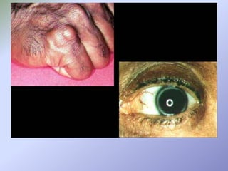 HIPERTRIGLICERIDEMIAAumento da viscosidade do sangue	alteração dos vasos de irrigação do pâncreas