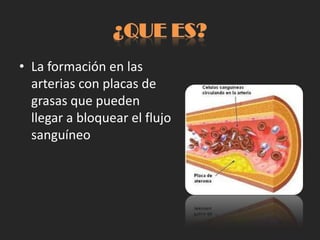 ¿QUE ES?
• La formación en las
  arterias con placas de
  grasas que pueden
  llegar a bloquear el flujo
  sanguíneo
 