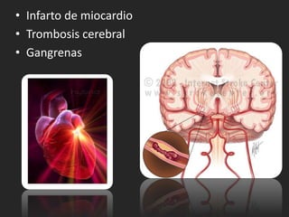 • Infarto de miocardio
• Trombosis cerebral
• Gangrenas
 
