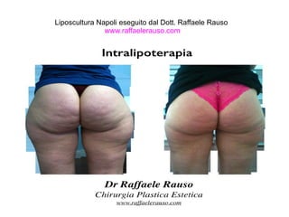 Liposcultura Napoli eseguito dal Dott. Raffaele Rauso 
www.raffaelerauso.com 
 