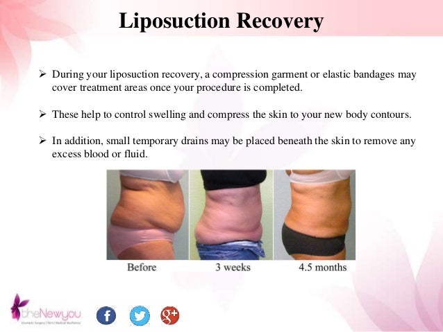 liposuction recovery liposuction recovery