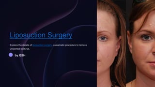 Liposuction Surgery
Explore the details of liposuction surgery, a cosmetic procedure to remove
unwanted body fat.
by QSH
 