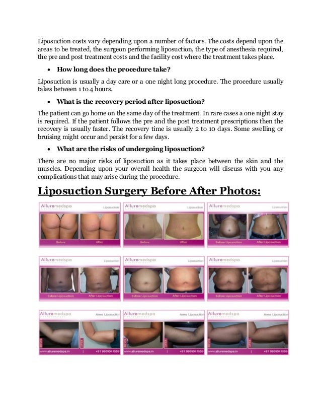 liposuction