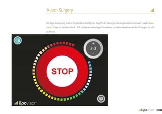 Alarm Surgery
Wichtige Anmerkung: Erreicht die Fettdicke mithilfe des Eingriffs des Chirurgen den eingestellten Grenzwert, meldet Lipo-
visor™ dies mit der Blinkschrift STOP und einem eindeutigen Tonzeichen, um die Aufmerksamkeit des Chirurgen auf sich
zu lenken.
121
 