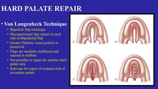 Cleft lip and palate - Developmental Anamoly - clasiification | PPTX
