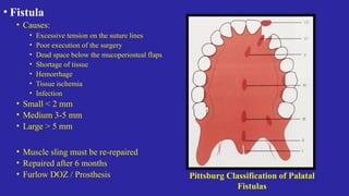 Cleft lip and palate - Developmental Anamoly - clasiification | PPTX