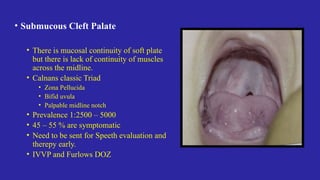 Cleft Lip And Palate Developmental Anamoly Clasiification PPTX Cleft Lip And Palate Developmental Anamoly Clasiification PPTX