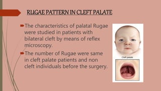 RUGAE PATTERNIN CLEFT PALATE
The characteristics of palatal Rugae
were studied in patients with
bilateral cleft by means of reflex
microscopy.
The number of Rugae were same
in cleft palate patients and non
cleft individuals before the surgery.
 