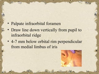 • Palpate infraorbital foramen
• Draw line down vertically from pupil to
  infraorbital ridge
• 4-7 mm below orbital rim perpendicular
  from medial limbus of iris
 