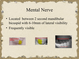 Mental Nerve
• Located between 2 second mandibular
  bicuspid with 6-10mm of lateral visibility
• Frequently visible
 