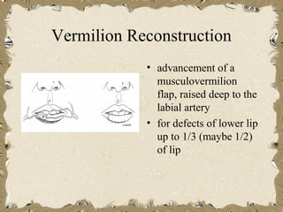 Vermilion Reconstruction
            • advancement of a
              musculovermilion
              flap, raised deep to the
              labial artery
            • for defects of lower lip
              up to 1/3 (maybe 1/2)
              of lip
 