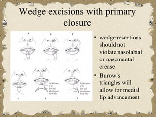 Wedge excisions with primary
          closure
                 • wedge resections
                   should not
                   violate nasolabial
                   or nasomental
                   crease
                 • Burow’s
                   triangles will
                   allow for medial
                   lip advancement
 