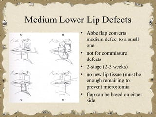 Medium Lower Lip Defects
            • Abbe flap converts
              medium defect to a small
              one
            • not for commissure
              defects
            • 2-stage (2-3 weeks)
            • no new lip tissue (must be
              enough remaining to
              prevent microstomia
            • flap can be based on either
              side
 