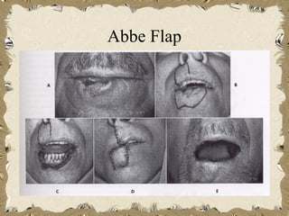 Abbe Flap
 