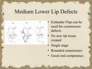 Medium Lower Lip Defects
            • Estlander Flap can be
              used for commissure
              defects
            • No new lip tissue
              created
            • Single stage
            • Rounded commissure
            • Good oral competence
 