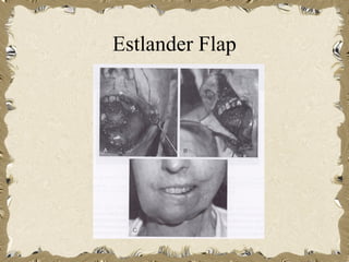 Estlander Flap
 