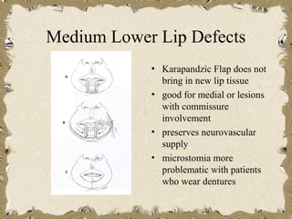Medium Lower Lip Defects
            • Karapandzic Flap does not
              bring in new lip tissue
            • good for medial or lesions
              with commissure
              involvement
            • preserves neurovascular
              supply
            • microstomia more
              problematic with patients
              who wear dentures
 