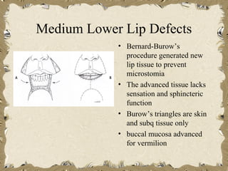 Medium Lower Lip Defects
            • Bernard-Burow’s
              procedure generated new
              lip tissue to prevent
              microstomia
            • The advanced tissue lacks
              sensation and sphincteric
              function
            • Burow’s triangles are skin
              and subq tissue only
            • buccal mucosa advanced
              for vermilion
 