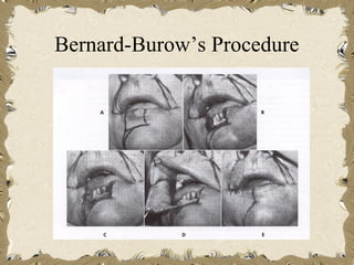 Bernard-Burow’s Procedure
 