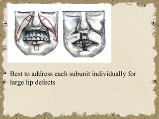 • Best to address each subunit individually for
  large lip defects
 