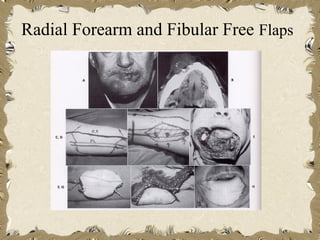 Radial Forearm and Fibular Free Flaps
 