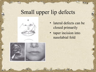 Small upper lip defects
            • lateral defects can be
              closed primarily
            • taper incision into
              nasolabial fold
 