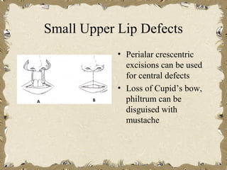 Small Upper Lip Defects
            • Perialar crescentric
              excisions can be used
              for central defects
            • Loss of Cupid’s bow,
              philtrum can be
              disguised with
              mustache
 