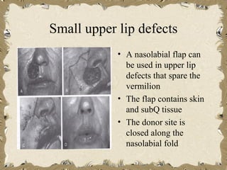 Small upper lip defects
            • A nasolabial flap can
              be used in upper lip
              defects that spare the
              vermilion
            • The flap contains skin
              and subQ tissue
            • The donor site is
              closed along the
              nasolabial fold
 