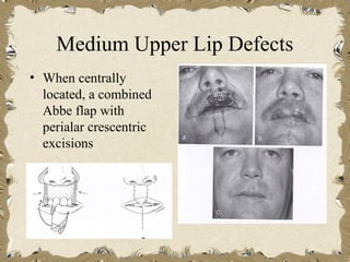 Medium Upper Lip Defects
• When centrally
  located, a combined
  Abbe flap with
  perialar crescentric
  excisions
 