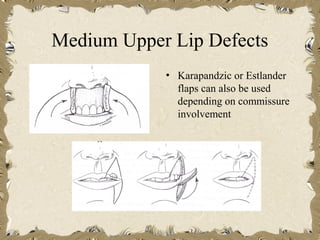 Medium Upper Lip Defects
            • Karapandzic or Estlander
              flaps can also be used
              depending on commissure
              involvement
 