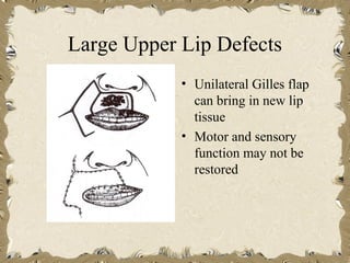 Large Upper Lip Defects
            • Unilateral Gilles flap
              can bring in new lip
              tissue
            • Motor and sensory
              function may not be
              restored
 
