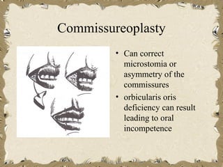 Commissureoplasty
         • Can correct
           microstomia or
           asymmetry of the
           commissures
         • orbicularis oris
           deficiency can result
           leading to oral
           incompetence
 