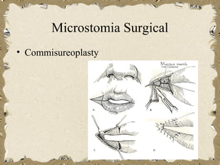 Microstomia Surgical
• Commisureoplasty
 