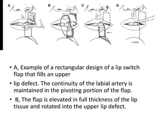 • A, Example of a rectangular design of a lip switch
flap that fills an upper
• lip defect. The continuity of the labial artery is
maintained in the pivoting portion of the flap.
• B, The flap is elevated in full thickness of the lip
tissue and rotated into the upper lip defect.
 