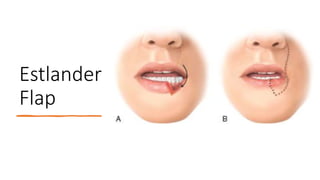 Lip Reconstruction: Algorithm for managing lip defects.pptx