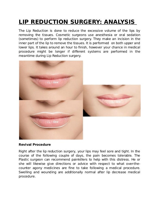 Lip Reduction Surgery Analysis lip reduction surgery analysis