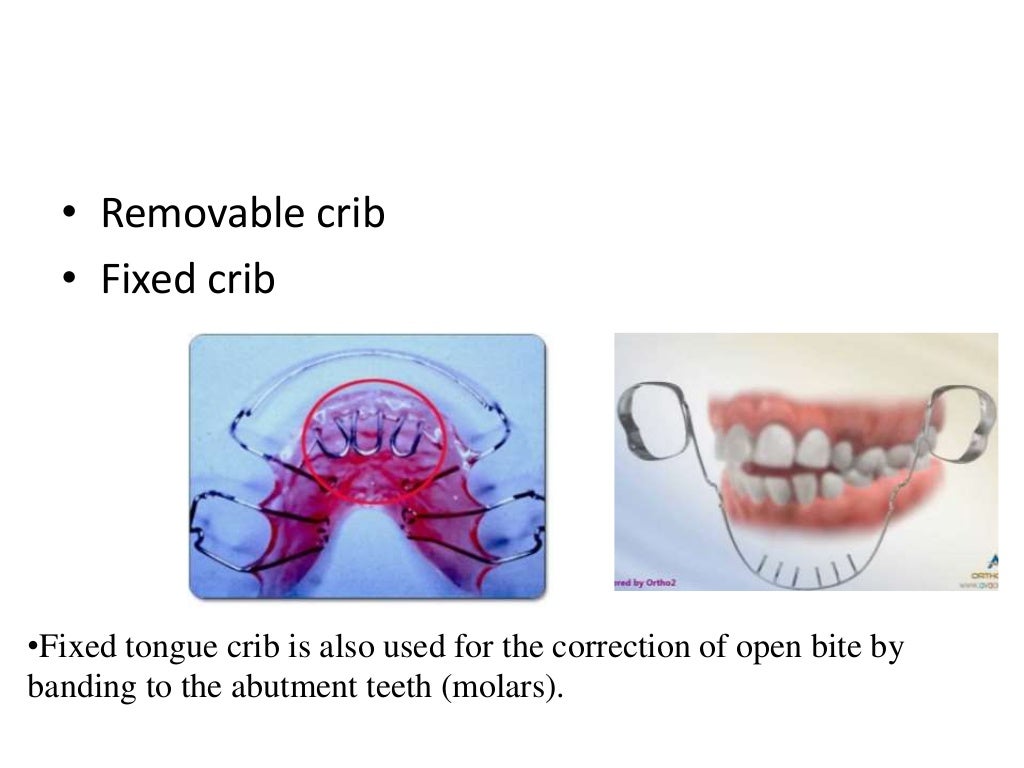 Lip bumper, quad helix, tongue crib,Tpa,Nance by Dr.Saurav Mishra