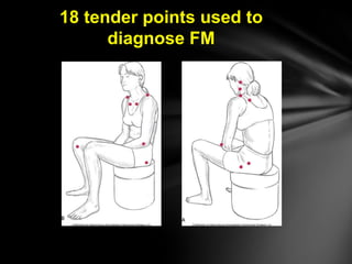 18 tender points used to
diagnose FM
 