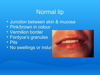 Normal lip
• Junction between skin & mucosa
• Pink/brown in colour
• Vermilion border
• Fordyce’s granules
• Pits
• No swellings or indurations
 