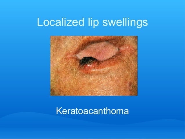 Lip tongue lesionsquick summary