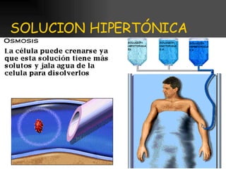 SOLUCION HIPERTÓNICA 