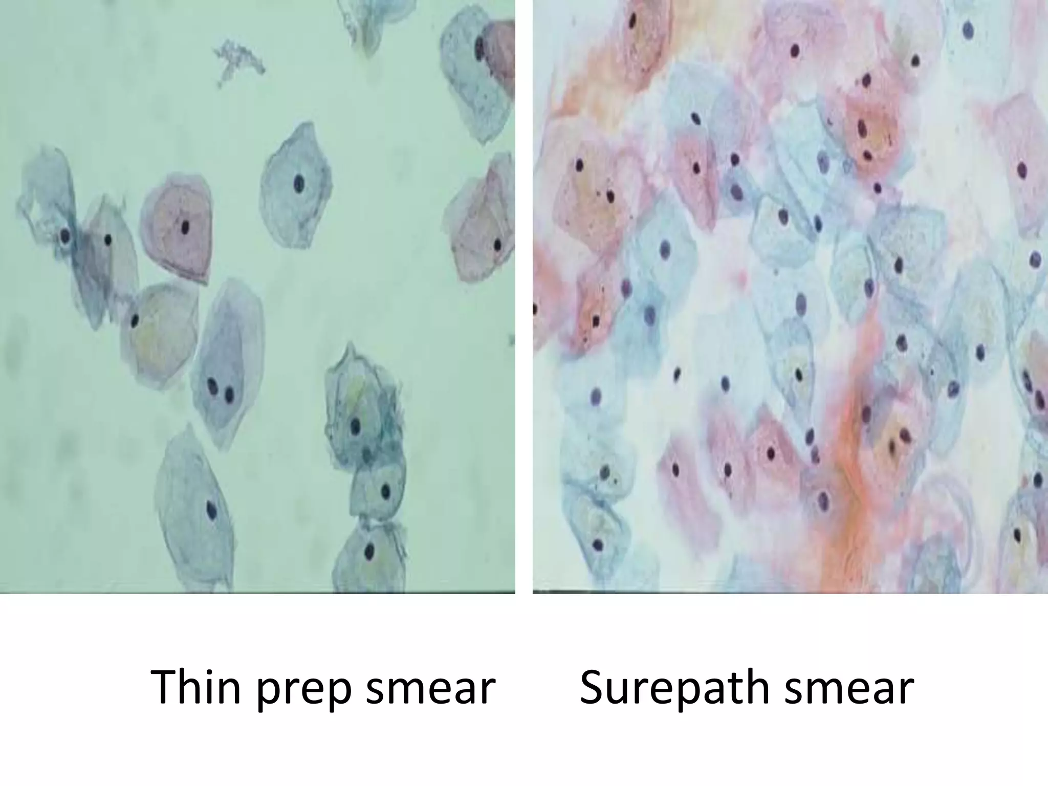 Surepath Slide Prep Liquid based cytology | PPTX