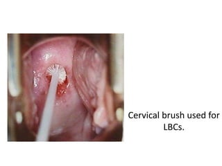 Cervical brush used for
LBCs.
 