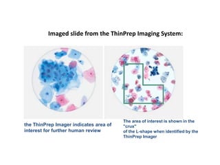 Imaged slide from the ThinPrep Imaging System:
The area of interest is shown in the
"crux"
of the L-shape when identified by the
ThinPrep Imager
the ThinPrep Imager indicates area of
interest for further human review
 