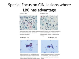 Special Focus on CIN Lesions where
LBC has advantage
 