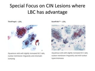 Special Focus on CIN Lesions where
LBC has advantage
 