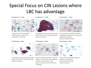Special Focus on CIN Lesions where
LBC has advantage
 