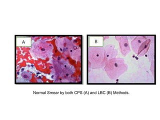 Normal Smear by both CPS (A) and LBC (B) Methods.
 